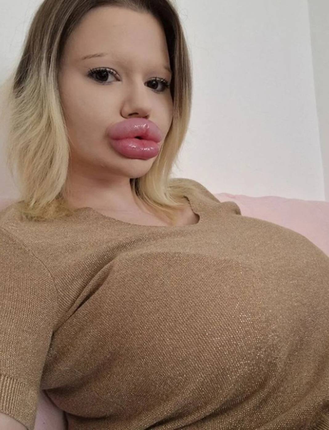 Dudak estetiğine harcadığı para 'dudak' uçuklattı 10